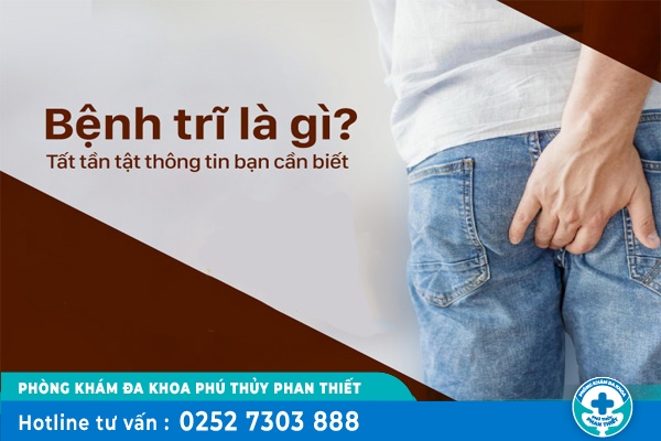 Dấu hiệu bệnh trĩ cấp độ 1,2,3,4 và cách điều trị