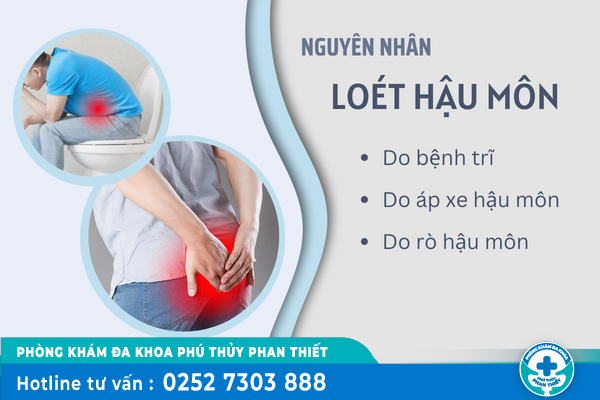 Loét hậu môn là bệnh gì và có nguy hiểm không?